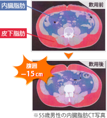 55歳男性の内臓脂肪CT写真